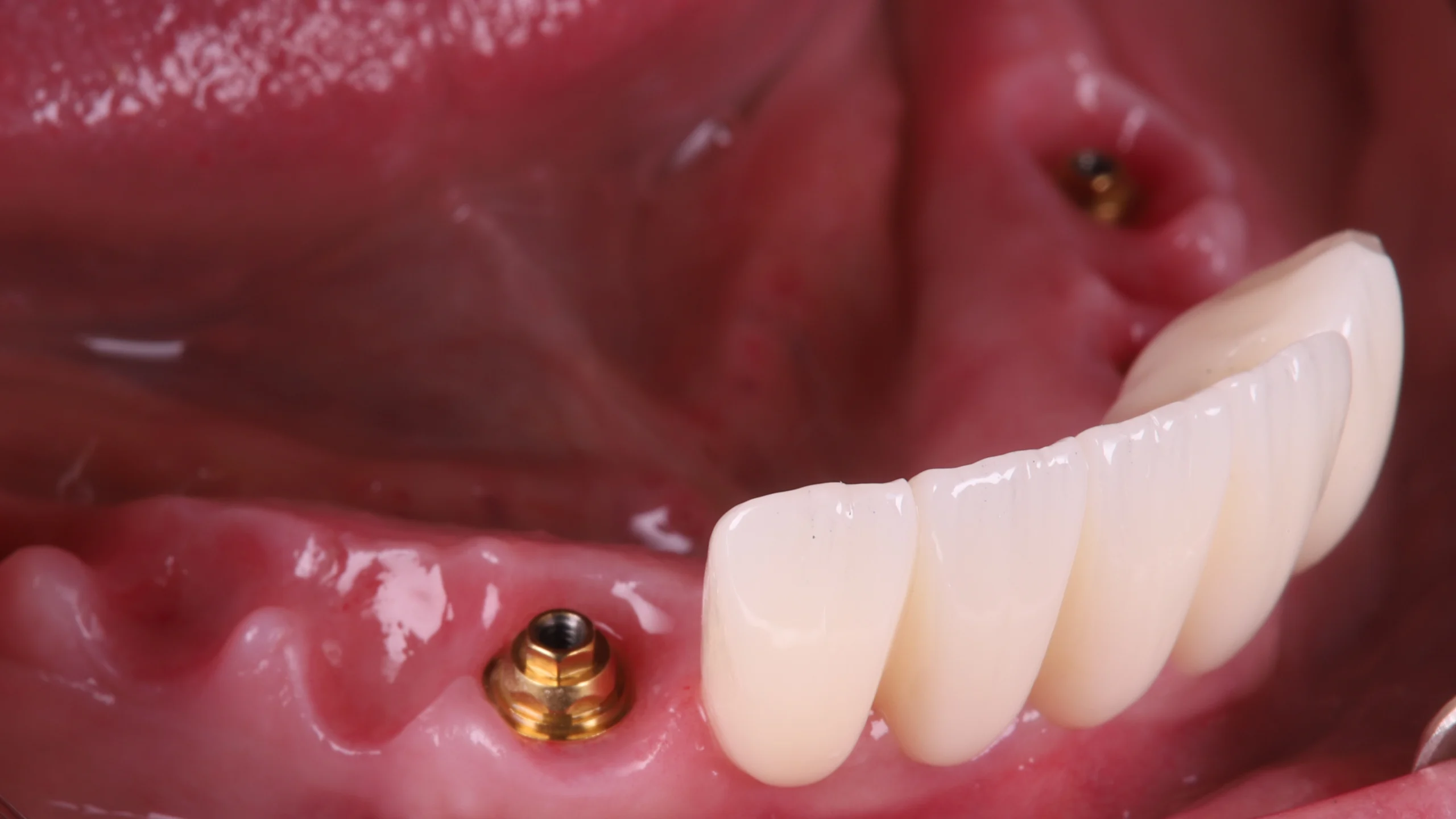 case 2 soft tissue 2