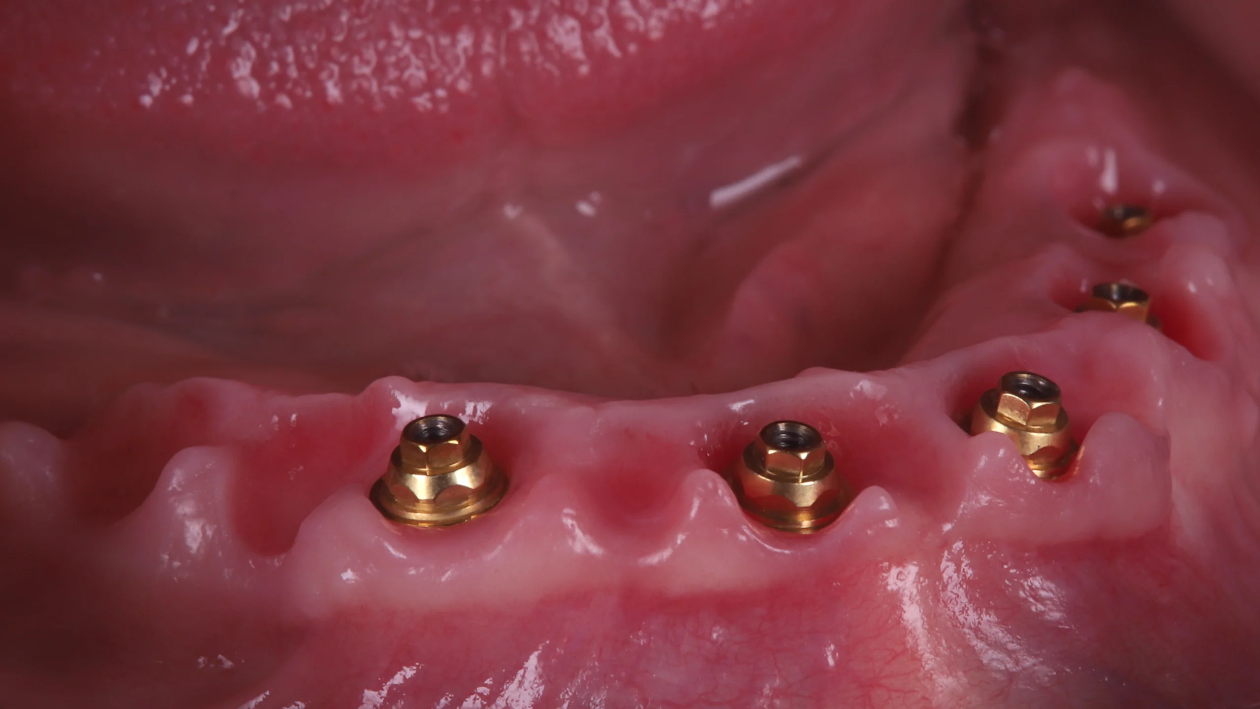 case 2 soft tissue