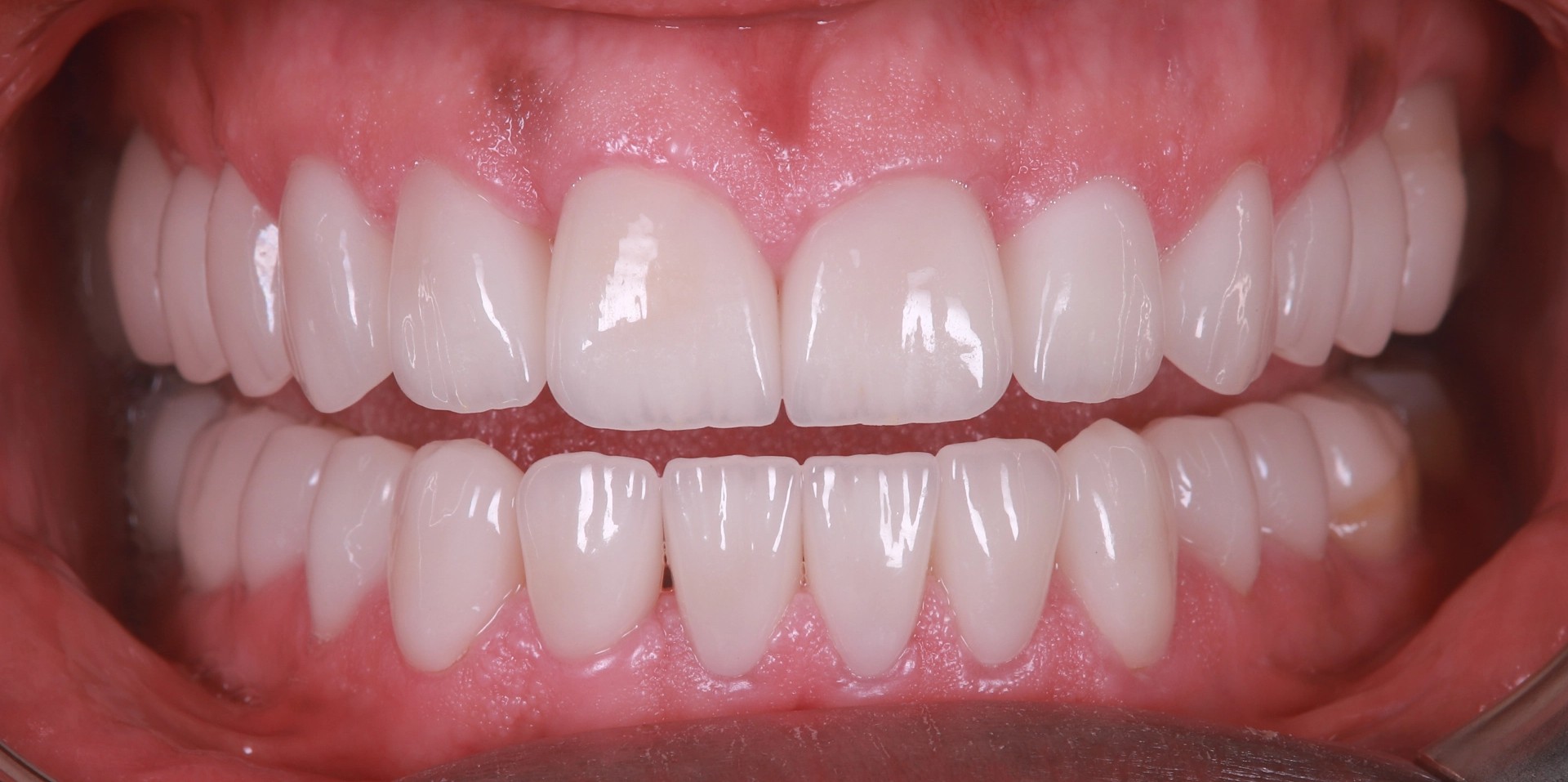 teeth-case-9-1-1