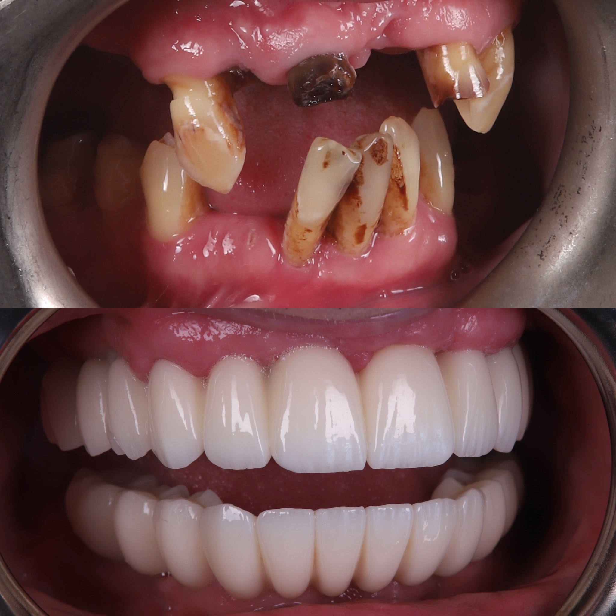 Before and after of dental restoration replaced by a full set of dental implants