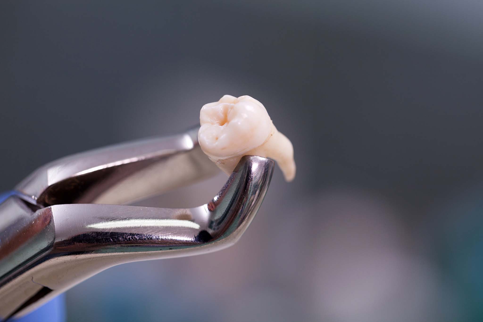Tooth extracted and held by dental forceps