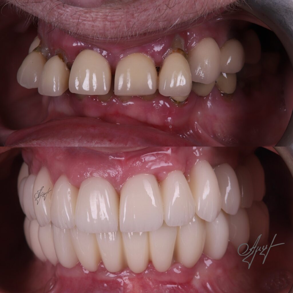 Before and after dental restoration with full implants
