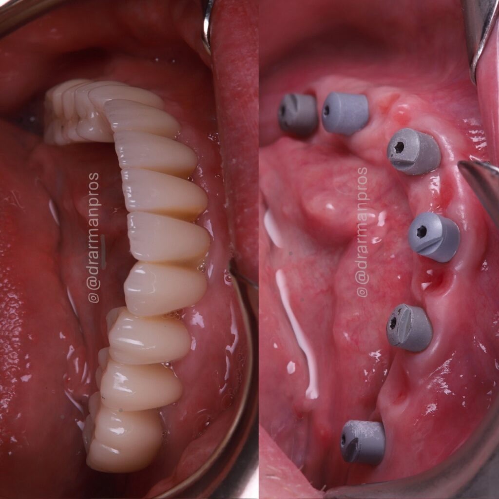 six dental implant abutments embedded in the gums