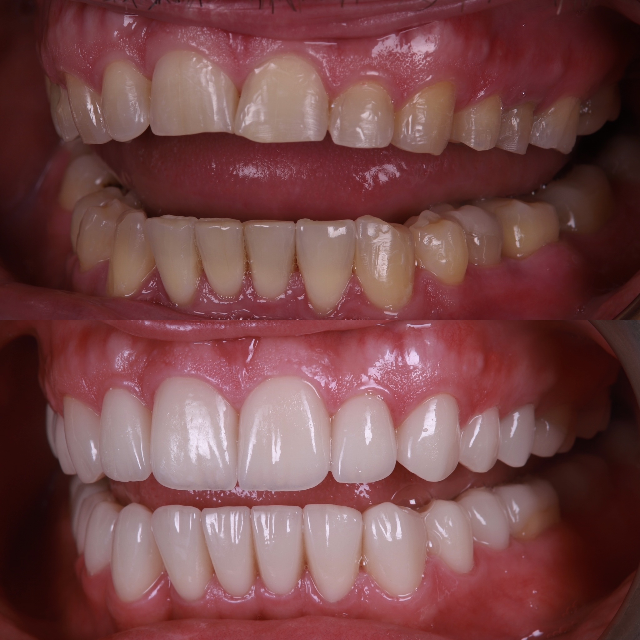 Dental Bruxism treatment Before and after