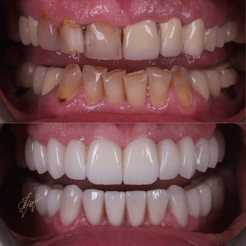 teeth damaged by bruxism with worn, chipped, and stained surfaces