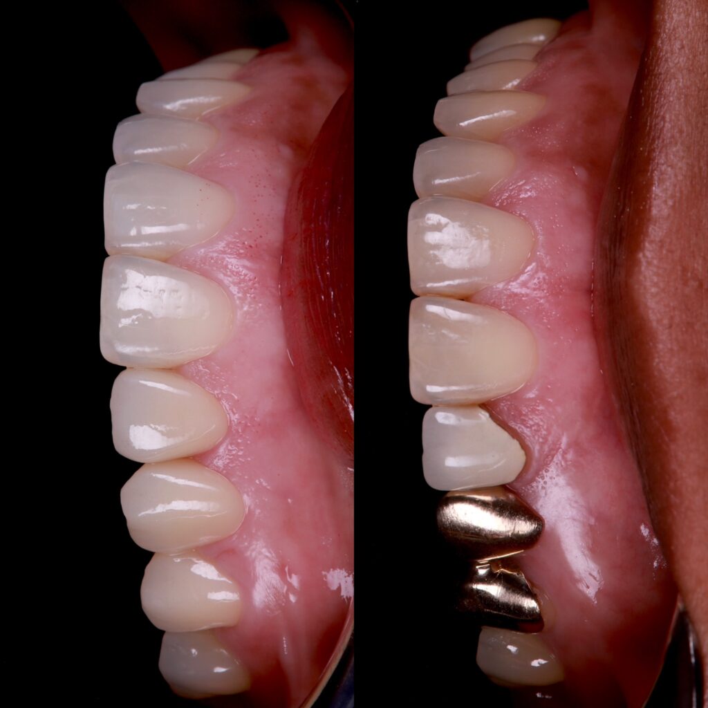 Before and after dental crown restoration with metal crown replaced by ceramic crown