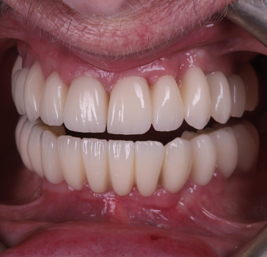 upper and lower prosthodontic dental restorations