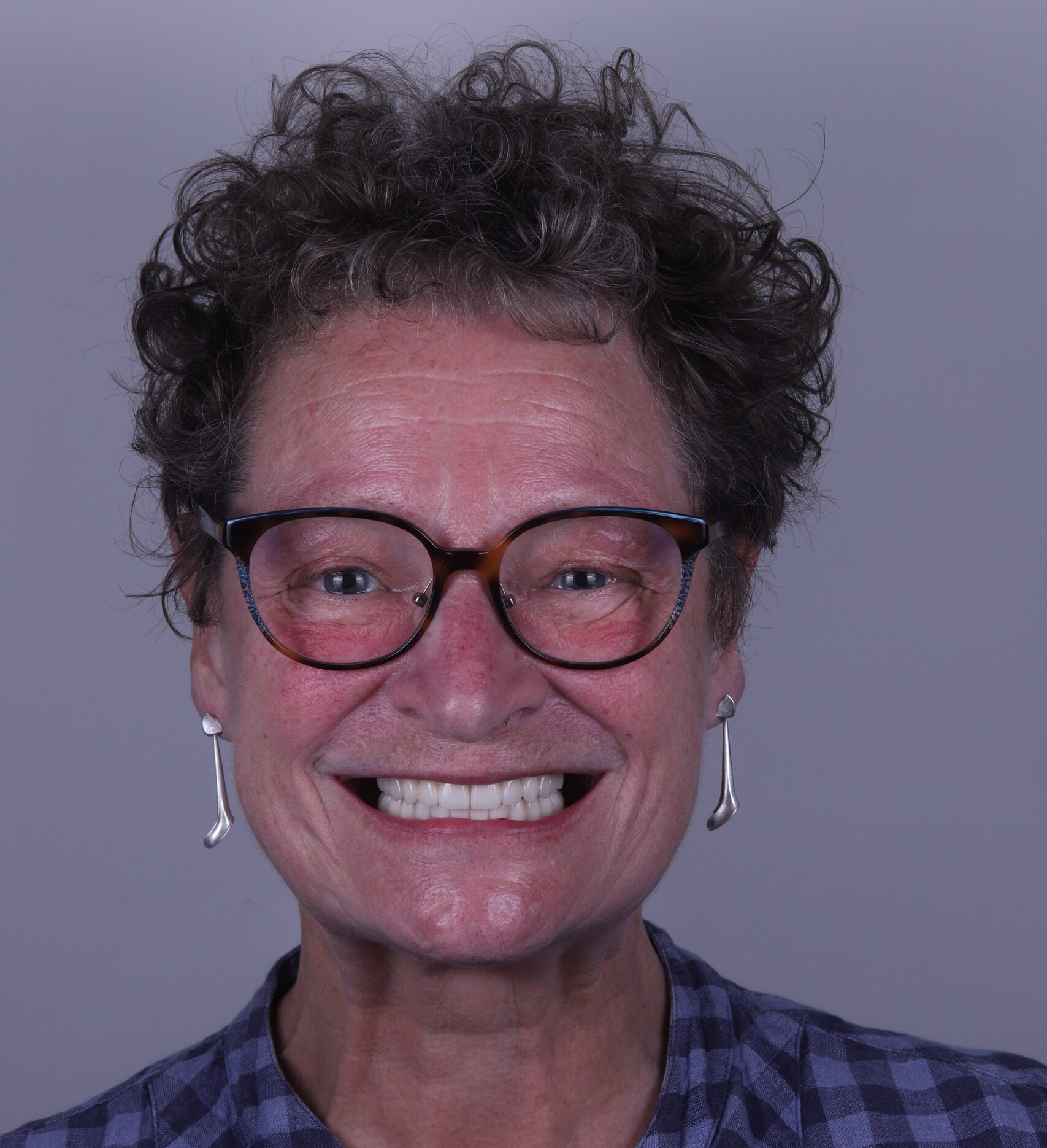 a middle-aged woman with set of prosthodontic teeth
