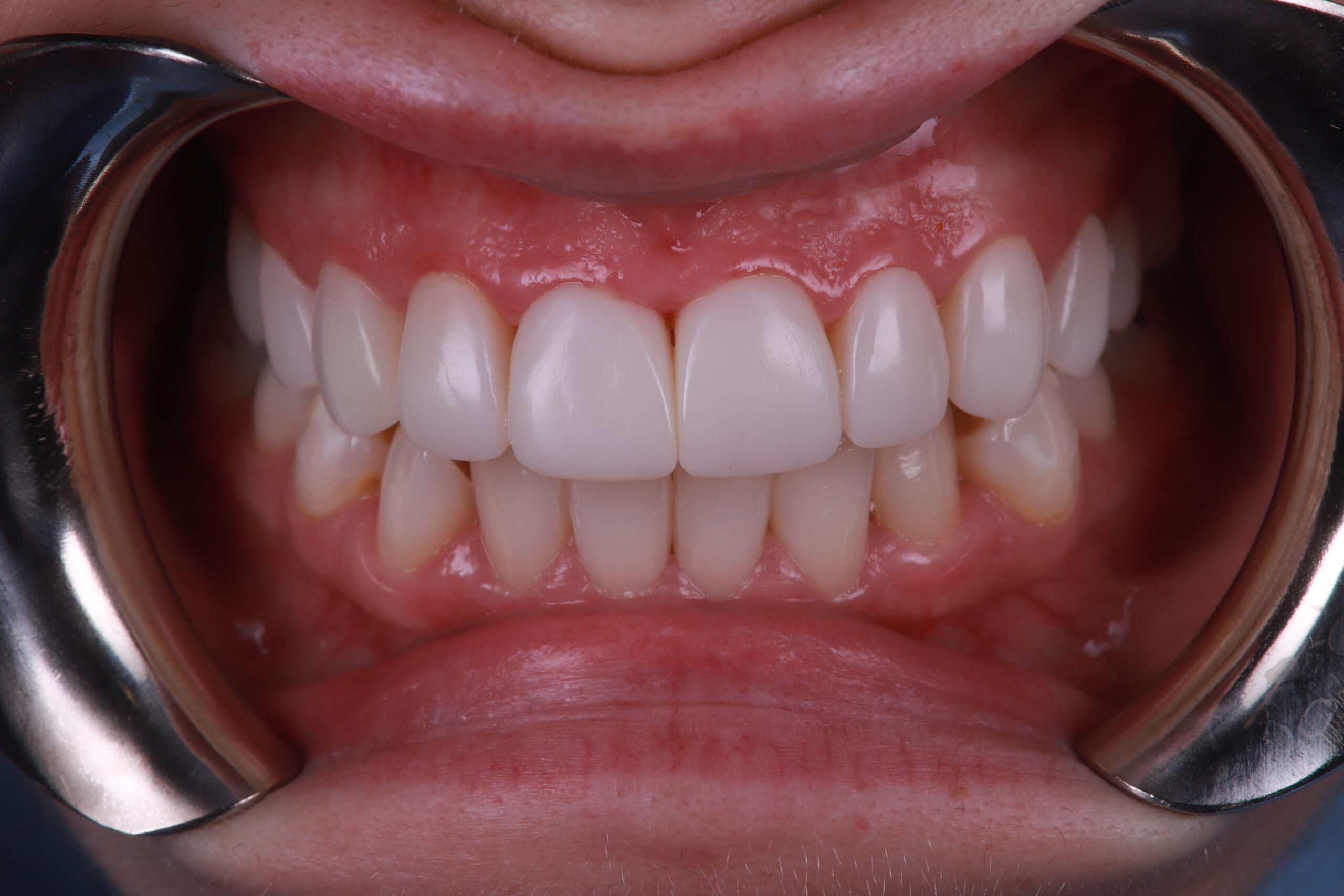 Close-up of teeth after composite bonding