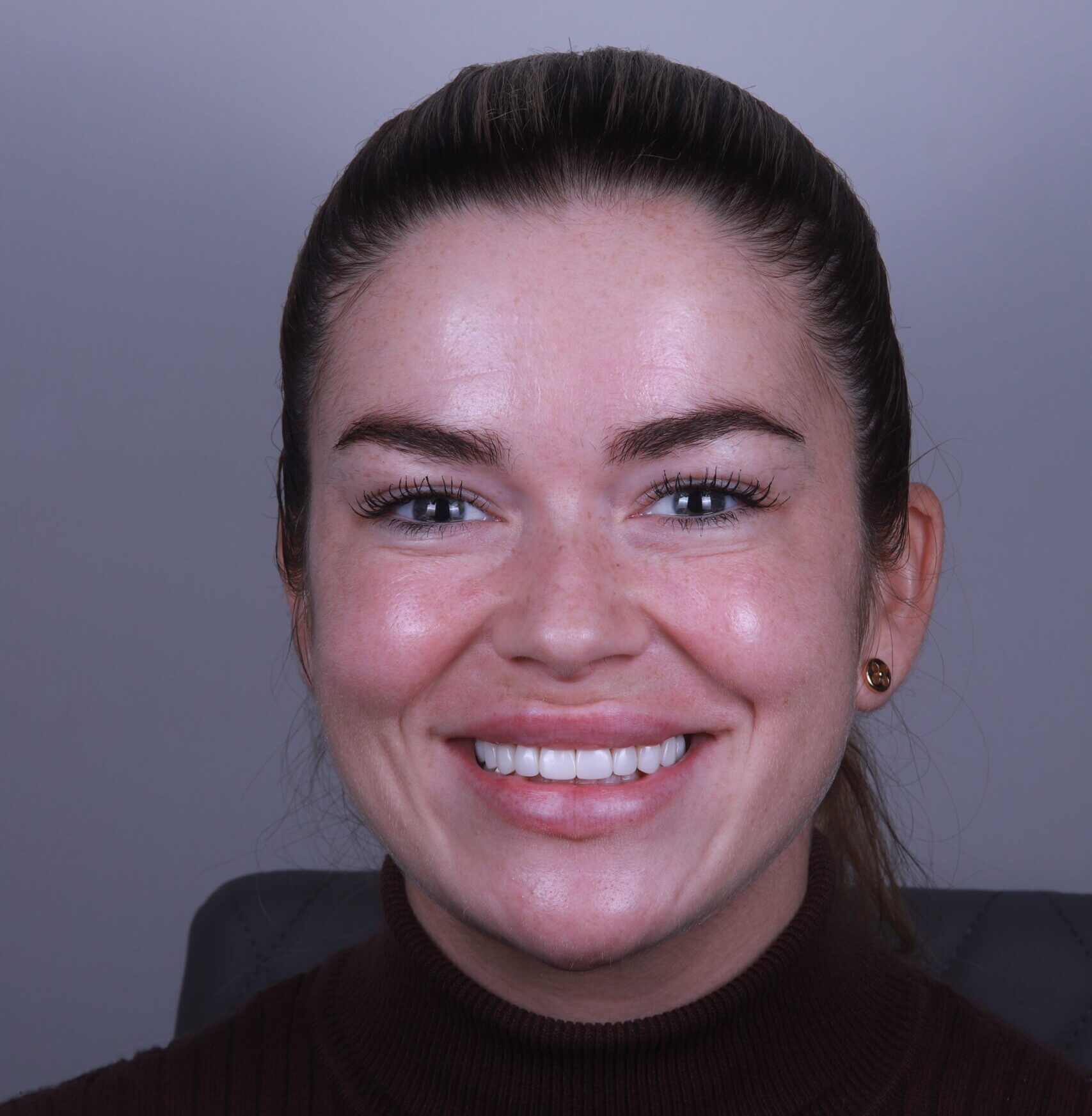 Close-up of a bright smile after composite bonding treatment