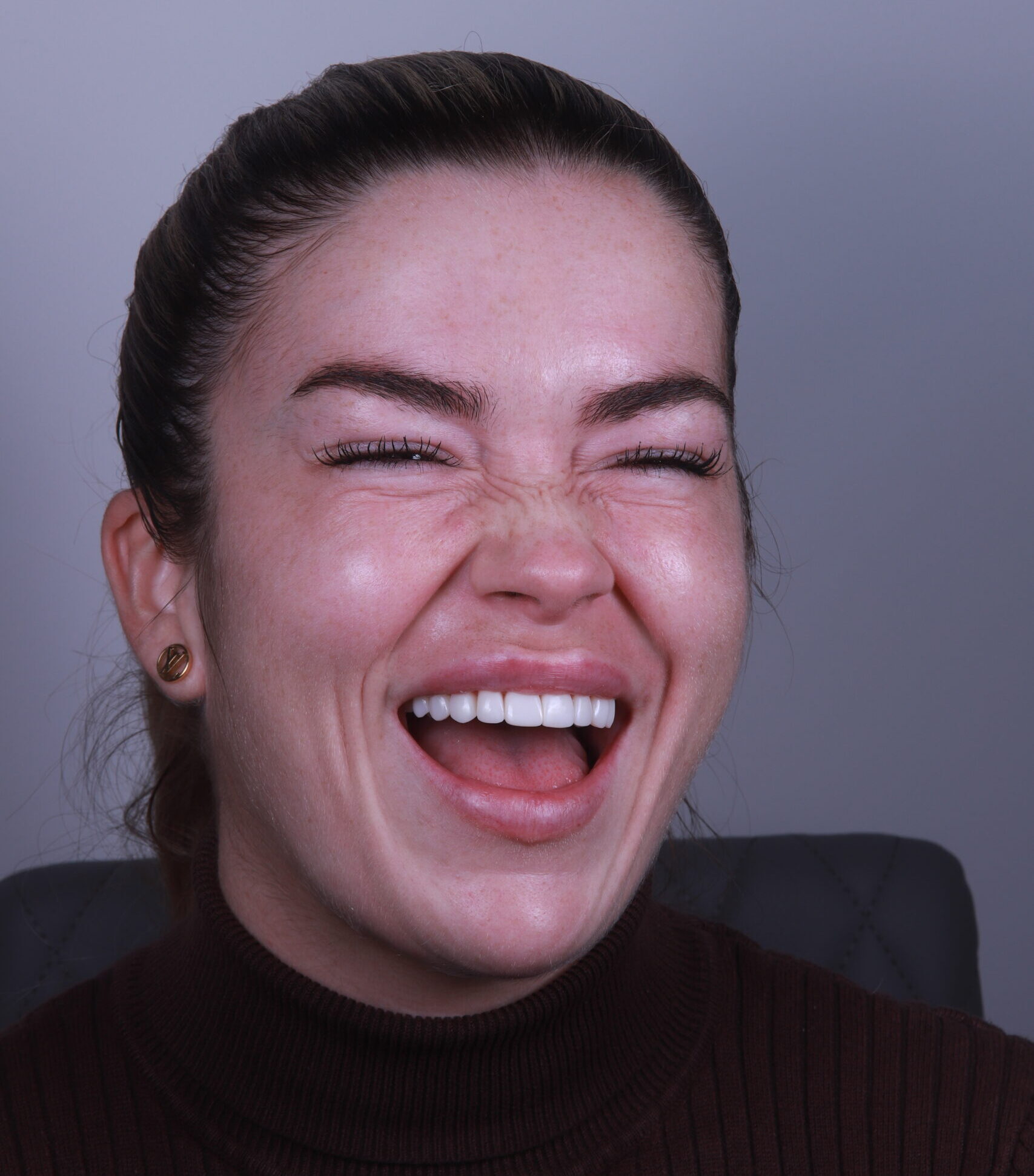 teeth after composite bonding treatment