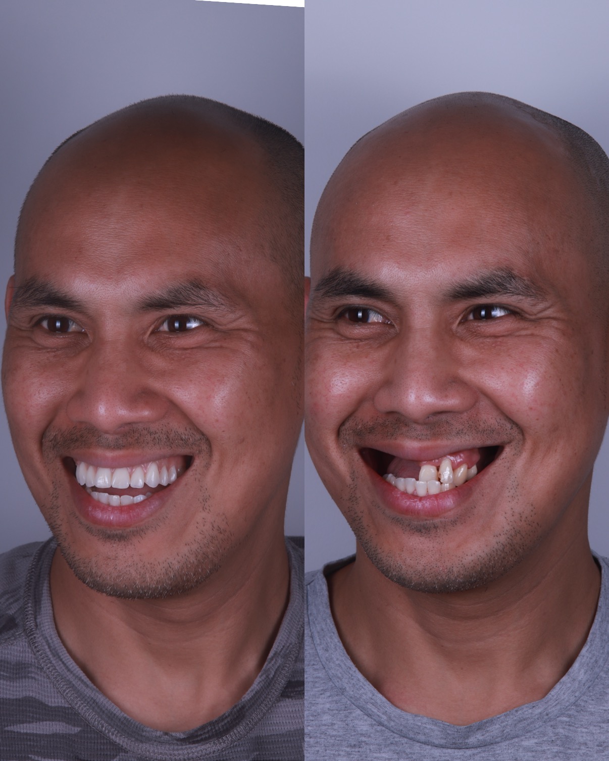 Before and after denture treatment