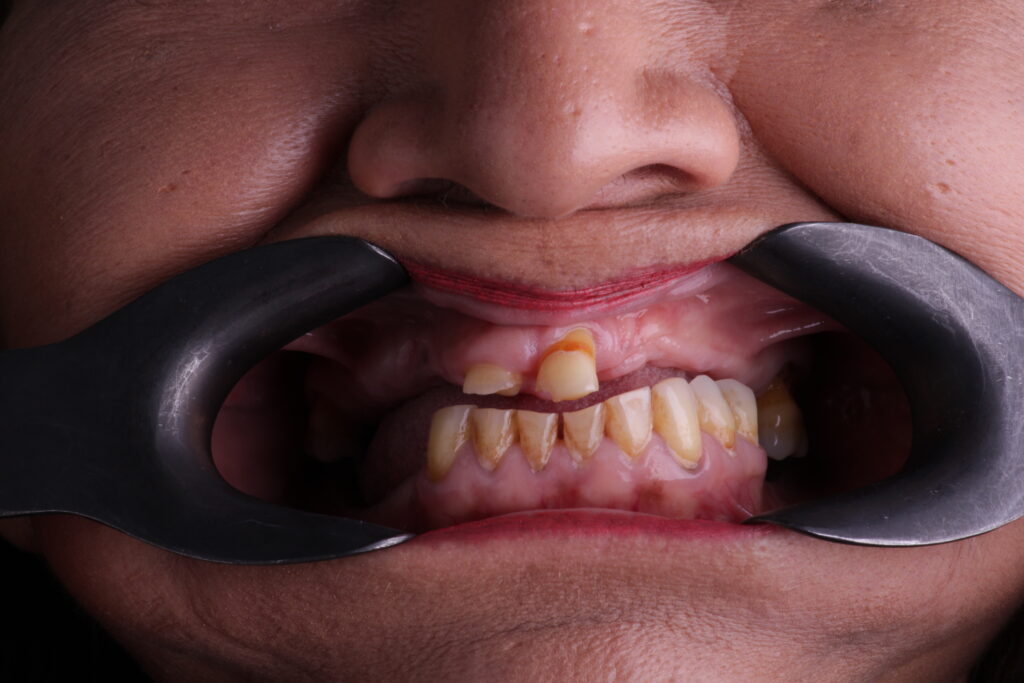 damaged teeth and inflamed gums due to bruxism