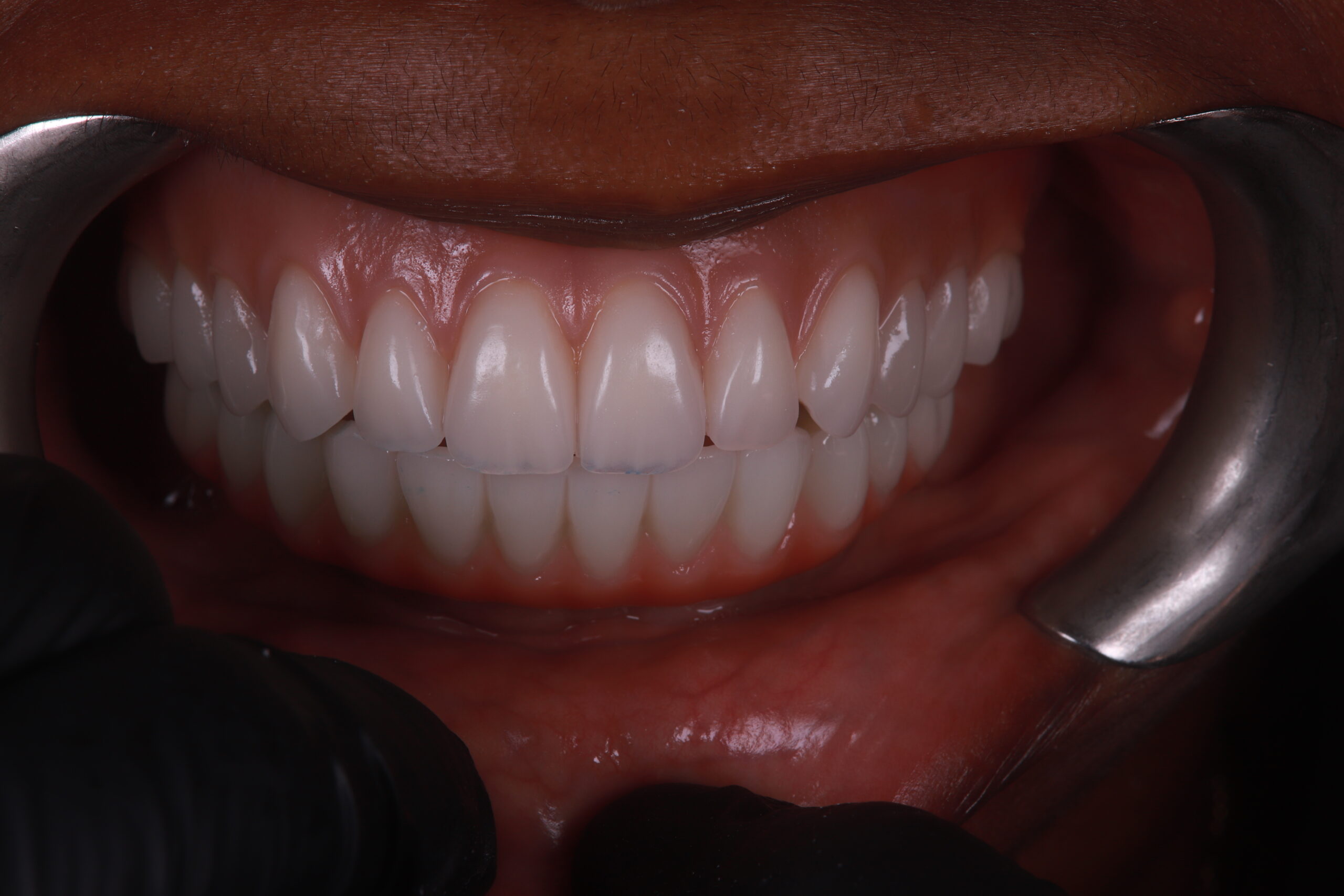 Close-up of full upper and lower dentures