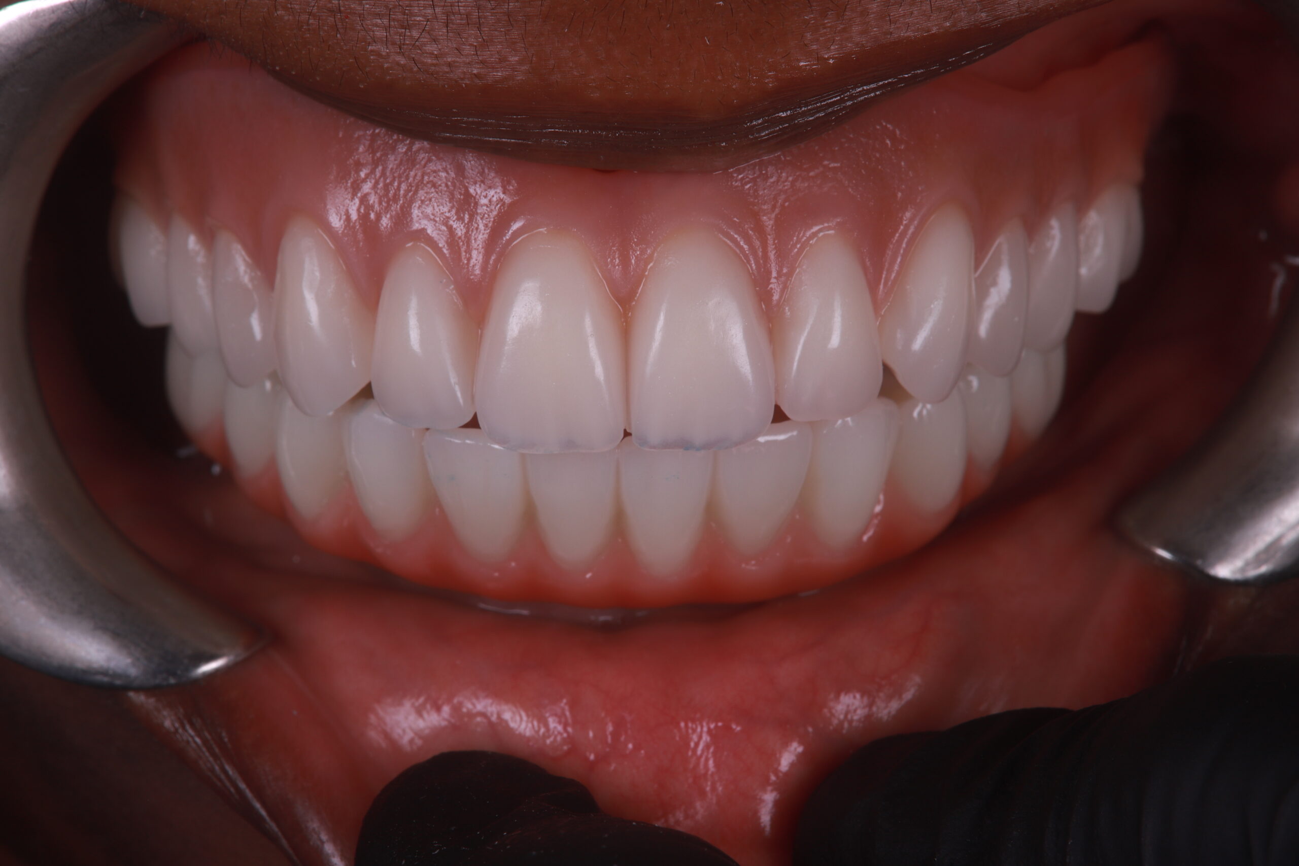 Close-up of veneers after smile makeover
