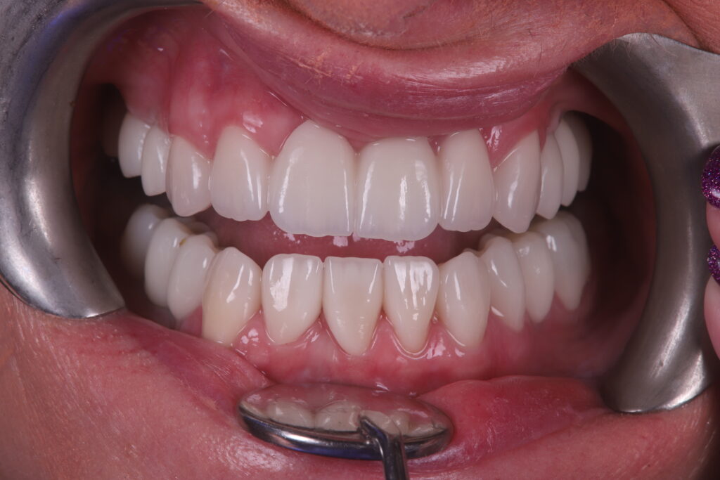 restored and natural-looking teeth