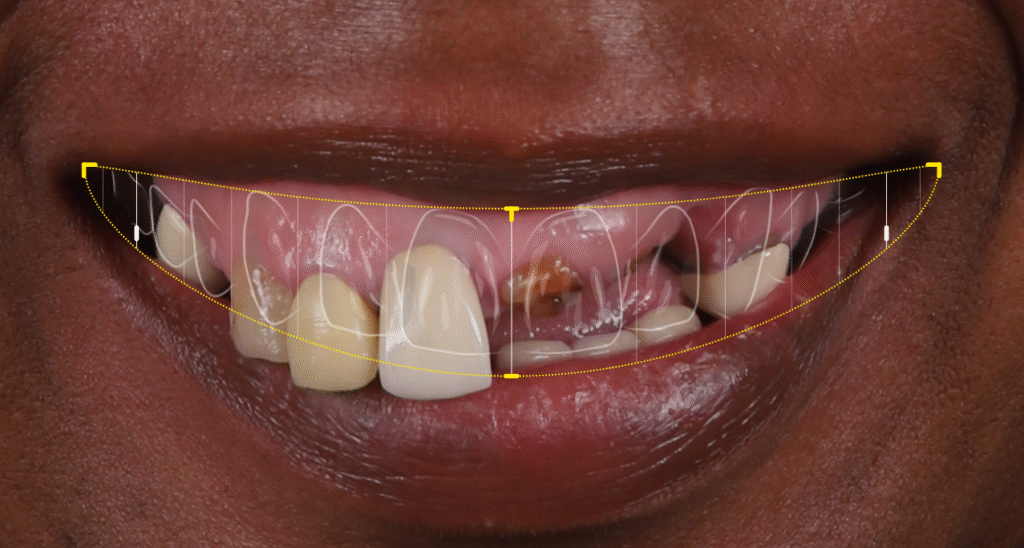 Digital denture design over damaged teeth