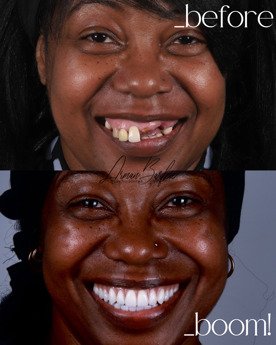 Before and after smile transformation with full dentures