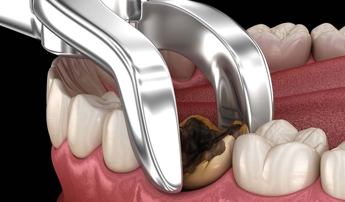 tooth extraction procedure using dental forceps