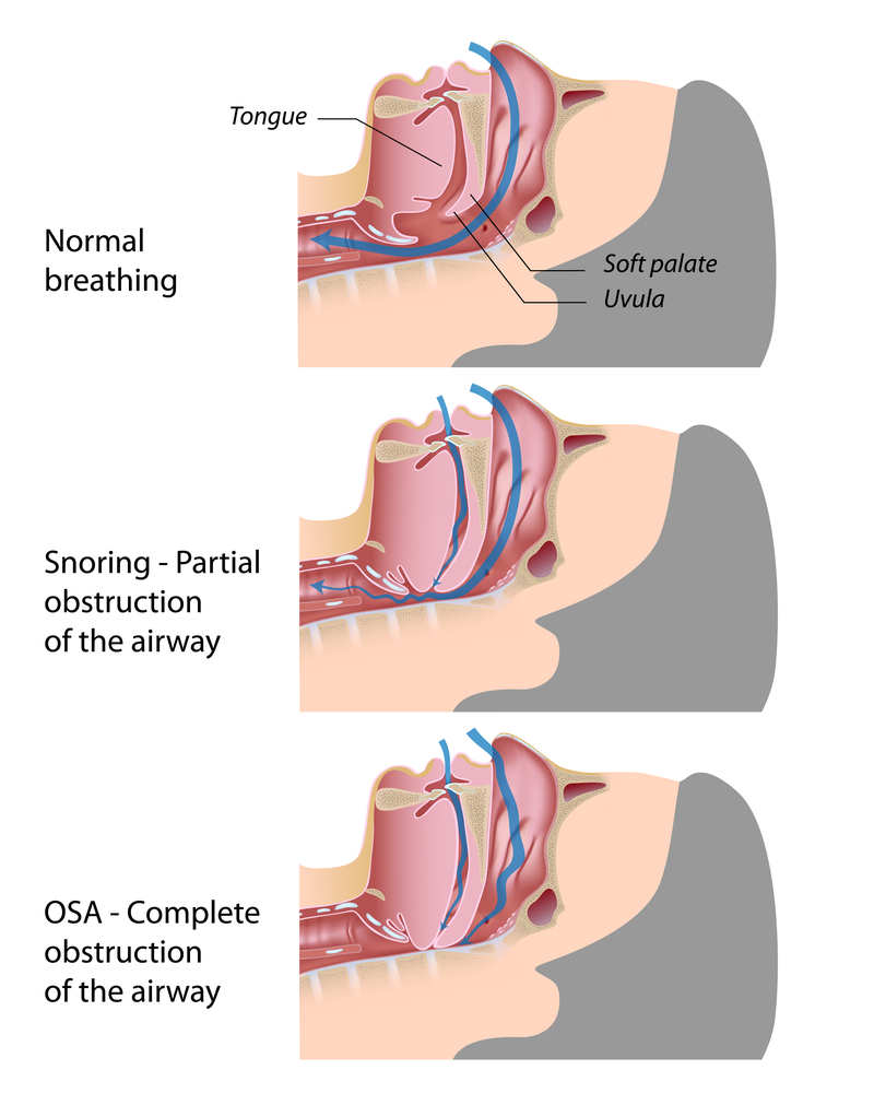 Diagram of normal breathing, snoring, and obstructive sleep apnoea airway blockage