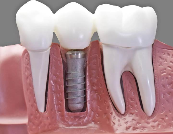 "Single dental implant illustration showing artificial tooth fixed with implant screw in jawbone