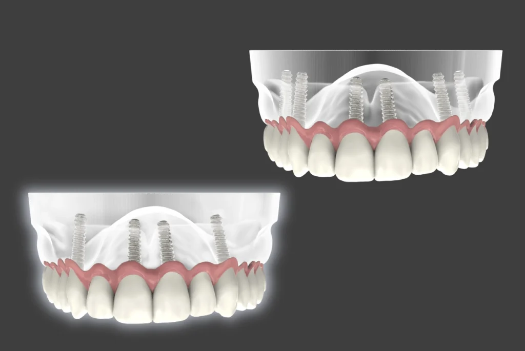 3D comparison between All-on-4 and All-on-6 dental implants