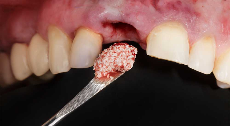 Bone Grafting- Dr Arman Barfeie Prosthodontist Official Website
