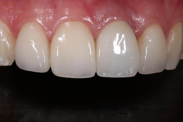Detailed view of high-quality dental implants, showing a natural and seamless appearance