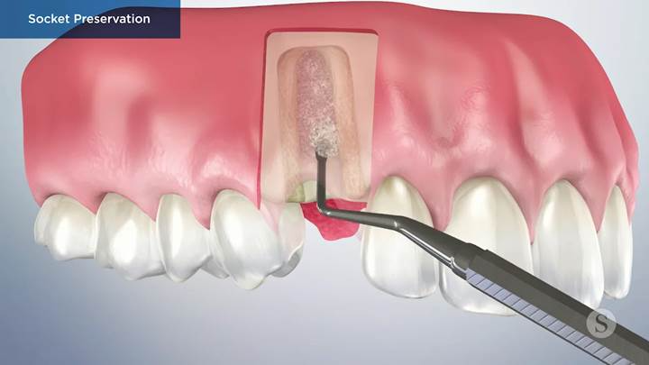 Bone Grafting- Dr Arman Barfeie Prosthodontist Official Website