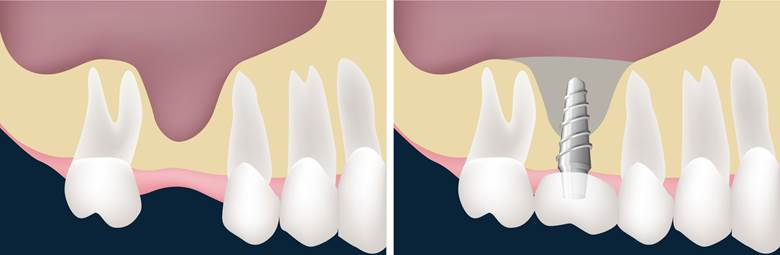 Bone Grafting- Dr Arman Barfeie Prosthodontist Official Website