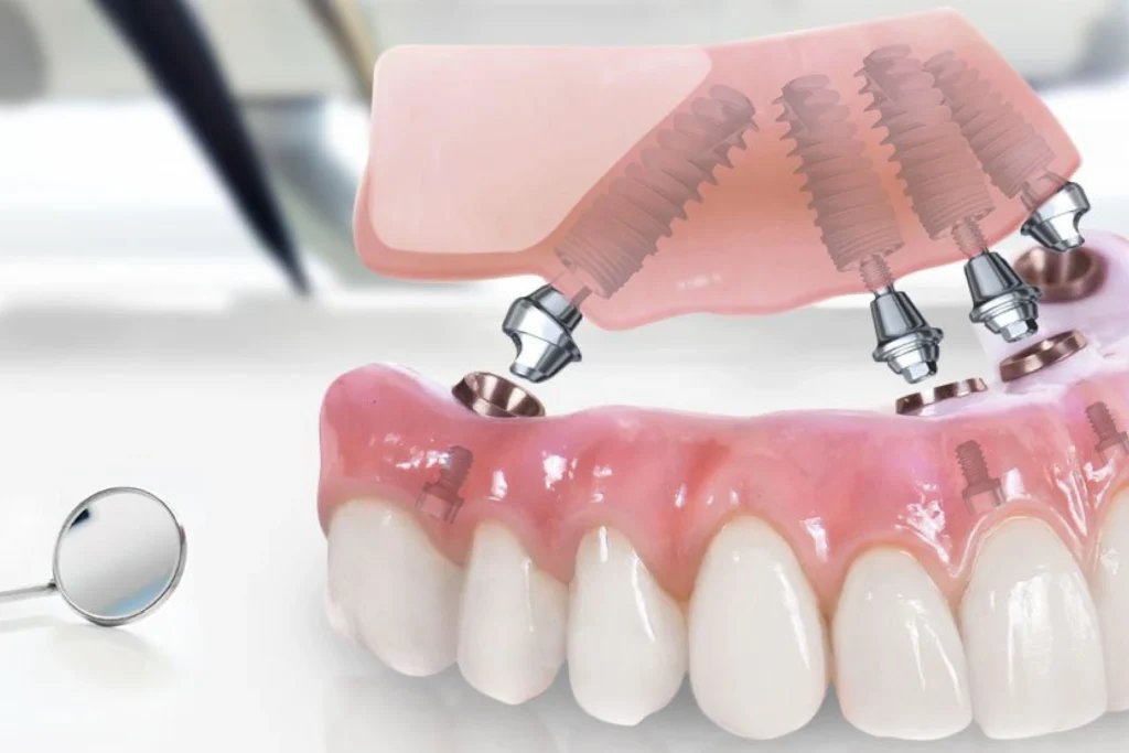All-on-4 dental implants with four angled implants securing a fixed full-arch prosthesis