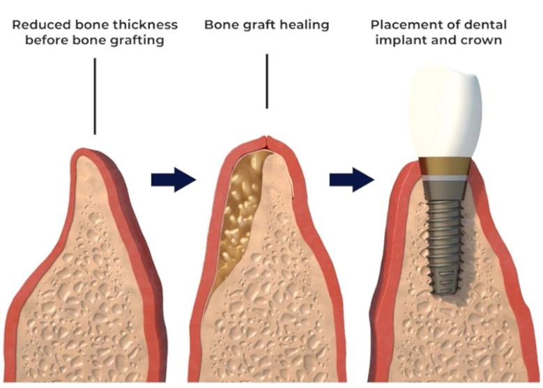 Bone Grafting- Dr Arman Barfeie Prosthodontist Official Website