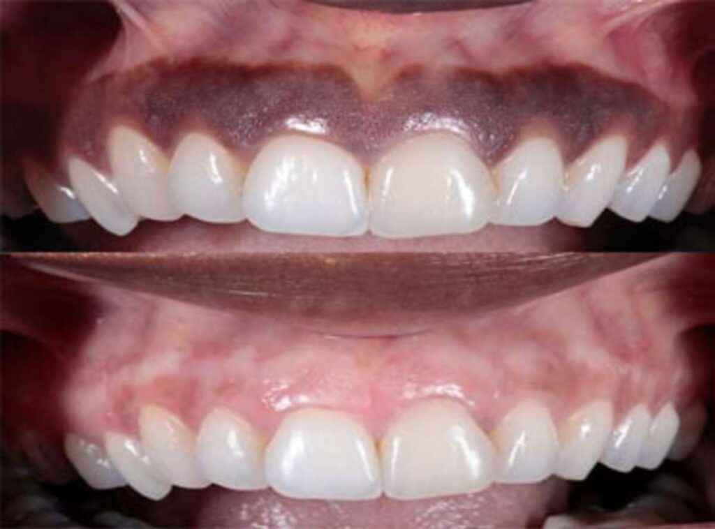 Before and after gum bleaching, showing lighter, more uniform gums