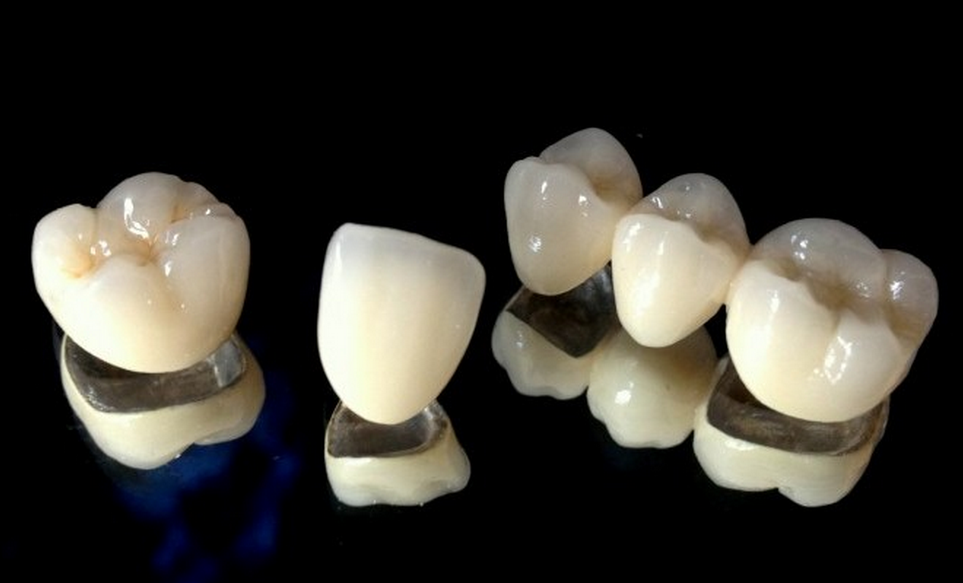 Ceramic dental crowns
