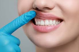 Close-up of a person pointing to their gums after undergoing gum bleaching