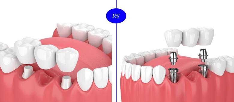 Comparison of traditional bridge vs. single dental implant with abutment
