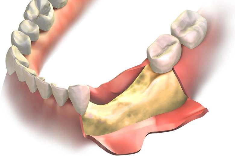 Bone Grafting- Dr Arman Barfeie Prosthodontist Official Website