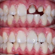 Before and after image showing the restoration of a missing tooth with a dental crown
