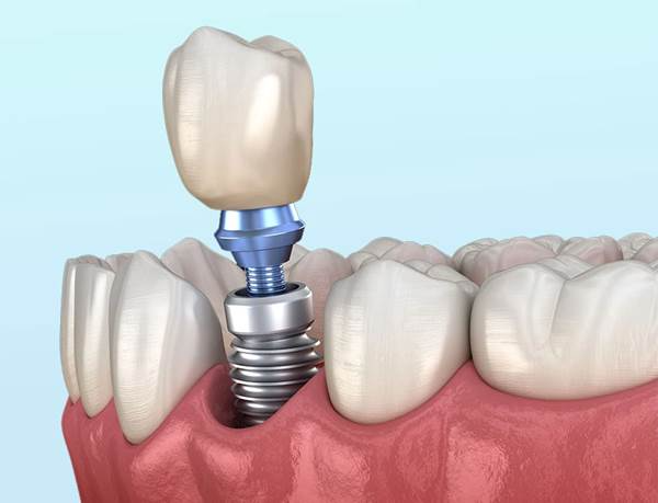single tooth dental implant cost