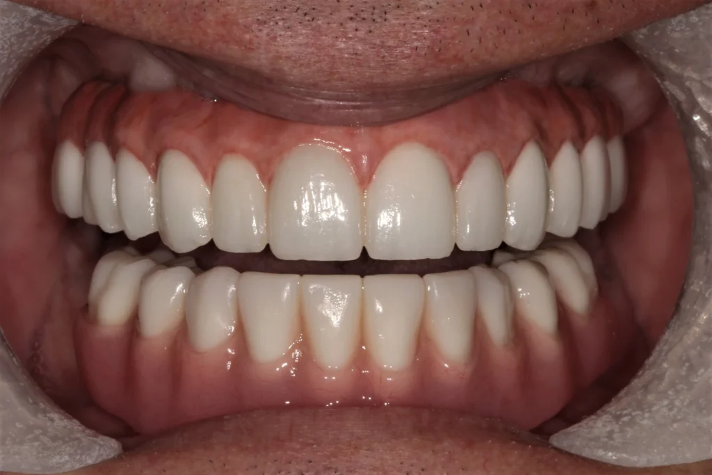 patient’s mouth with a completed full-arch restoration
