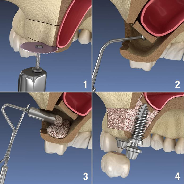 Bone Grafting- Dr Arman Barfeie Prosthodontist Official Website