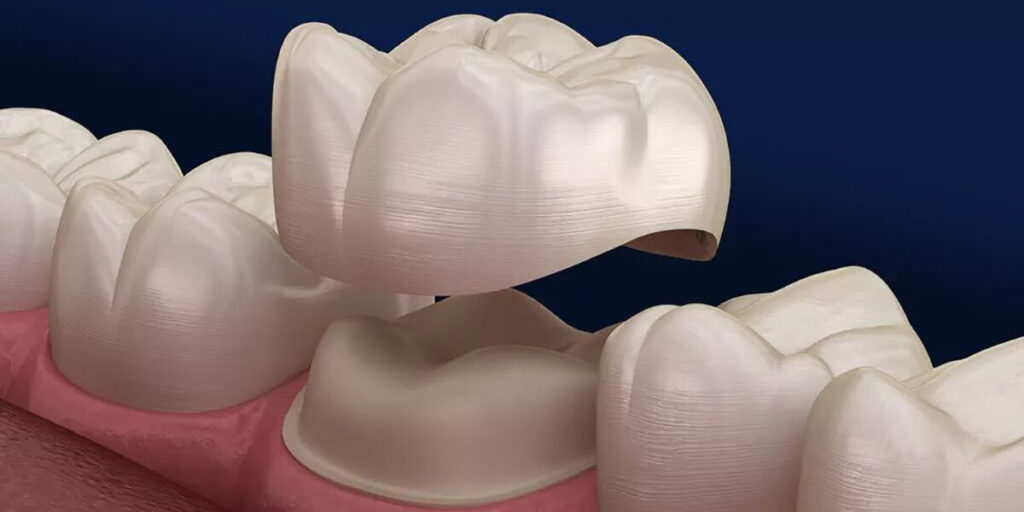 dental crown being placed over a tooth