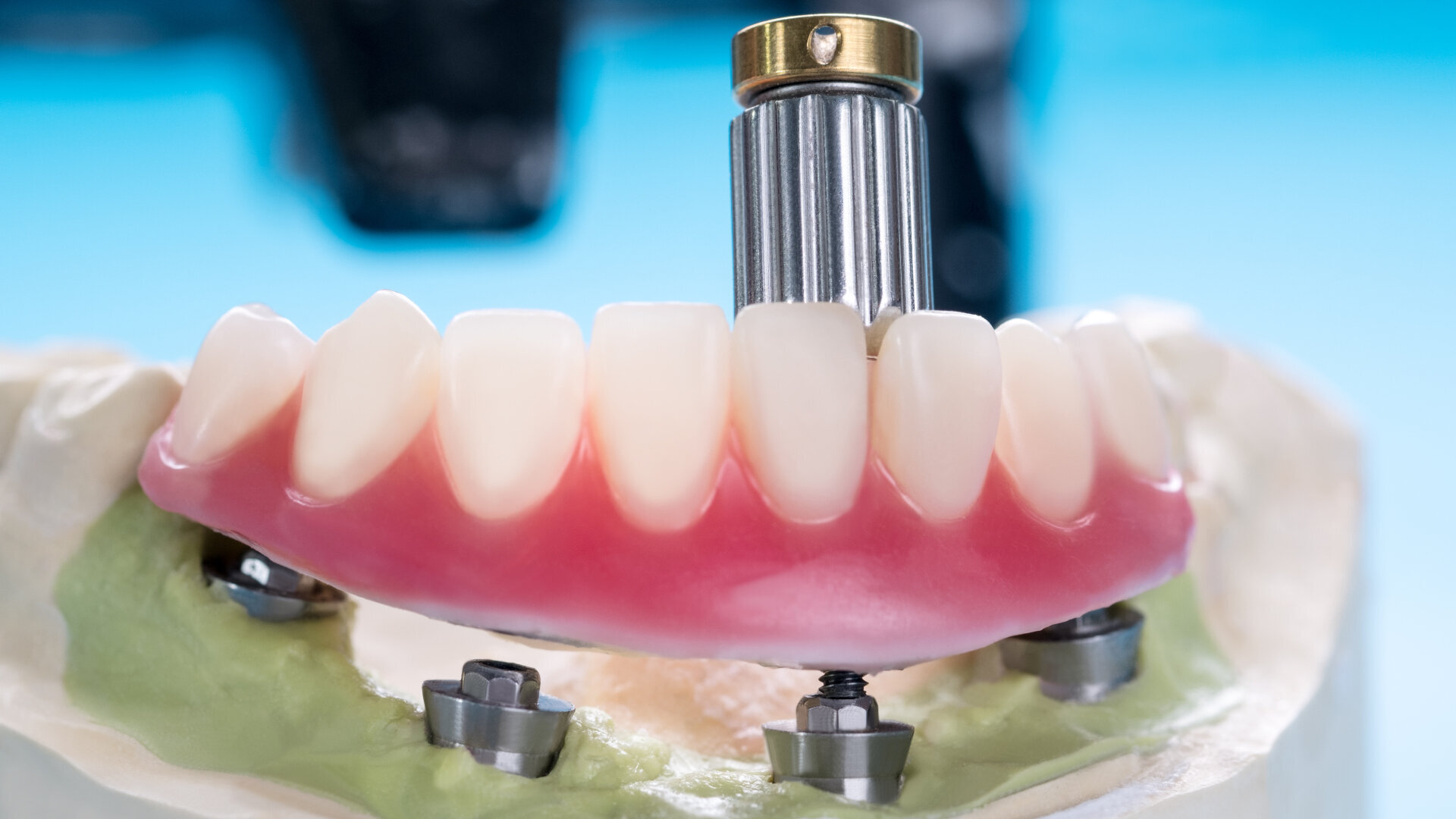 Implant Overdenture- Dr Arman Barfeie Prosthodontist Official Website
