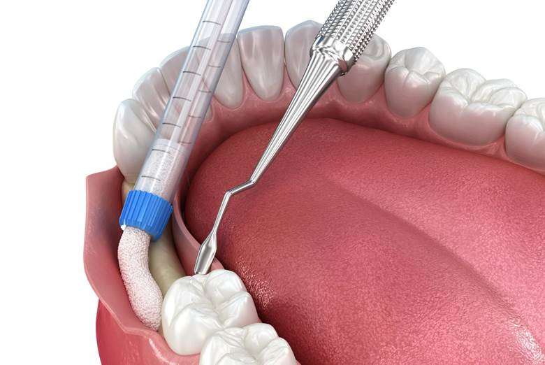 Bone Grafting- Dr Arman Barfeie Prosthodontist Official Website