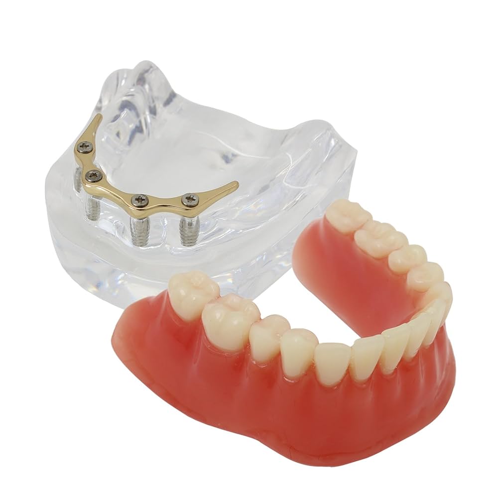 Implant Overdenture- Dr Arman Barfeie Prosthodontist Official Website