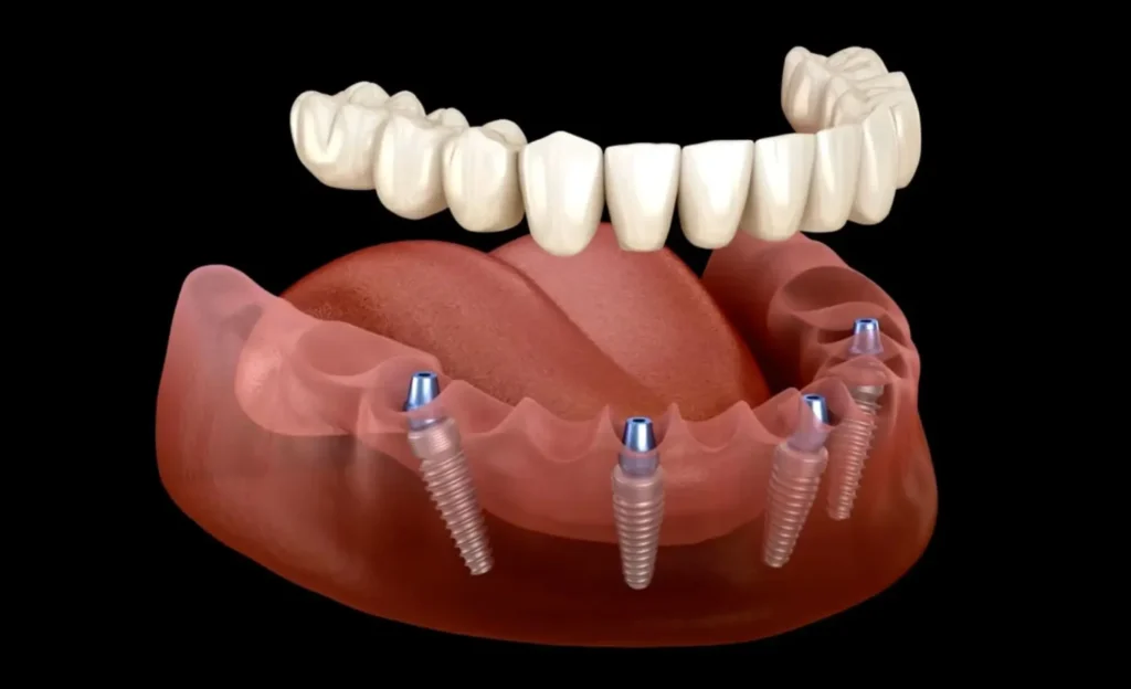 All on 4 /6 Dental Implants- Dr Arman Barfeie Prosthodontist Official Website