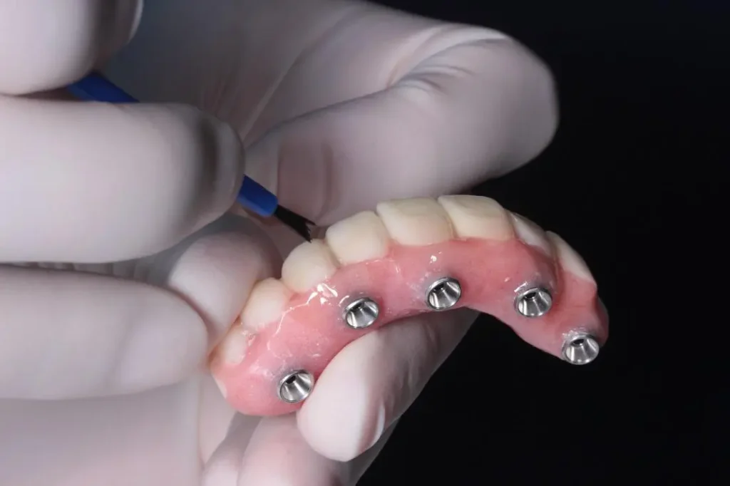 full-arch implant prosthesis with multiple abutments