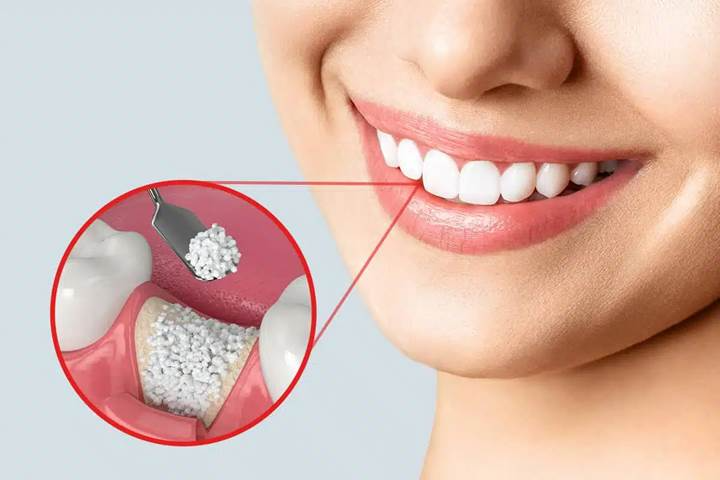 Bone Grafting- Dr Arman Barfeie Prosthodontist Official Website
