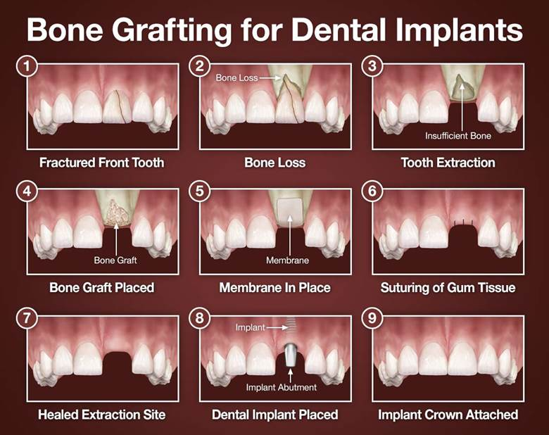 Bone Grafting- Dr Arman Barfeie Prosthodontist Official Website