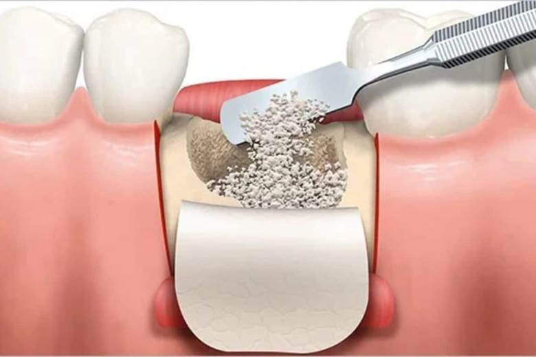 Bone Grafting- Dr Arman Barfeie Prosthodontist Official Website